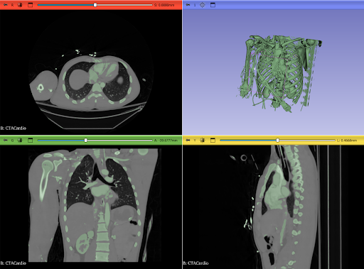 Segment anatomic modele