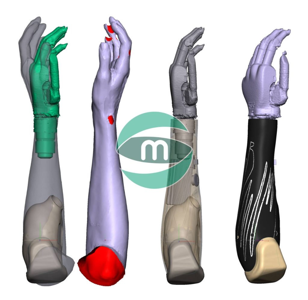 Design orthotic - Arm tatoo